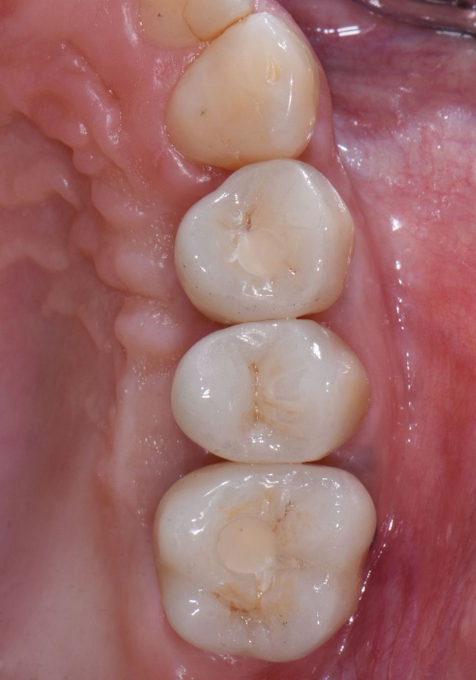 Figure 38 & Figure 39 & Figure 40 : Final result. Hard and soft tissue conditions were favorable and yielded a satisfying esthetic result. The radiograph showed a stable bone condition.
