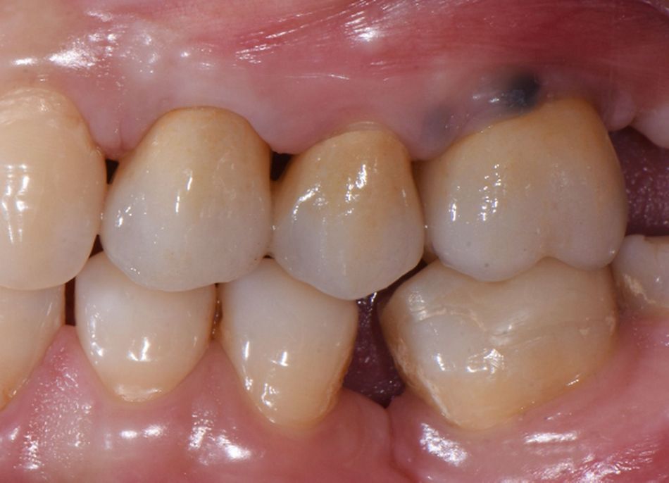 Figure 38 & Figure 39 & Figure 40 : Final result. Hard and soft tissue conditions were favorable and yielded a satisfying esthetic result. The radiograph showed a stable bone condition.