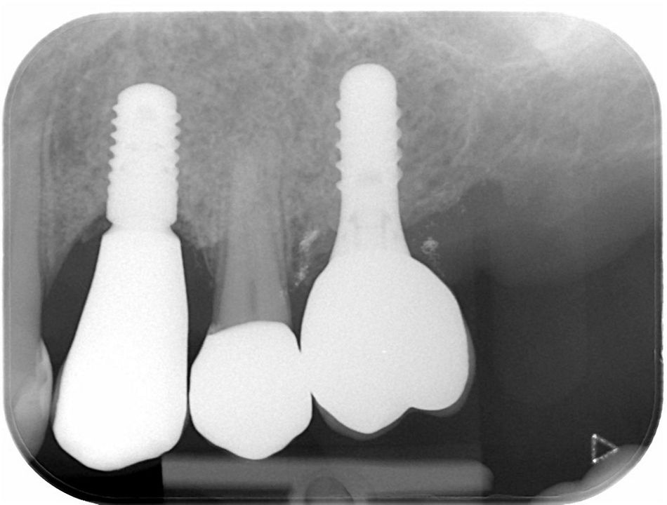 Figure 38 & Figure 39 & Figure 40 : Final result. Hard and soft tissue conditions were favorable and yielded a satisfying esthetic result. The radiograph showed a stable bone condition.