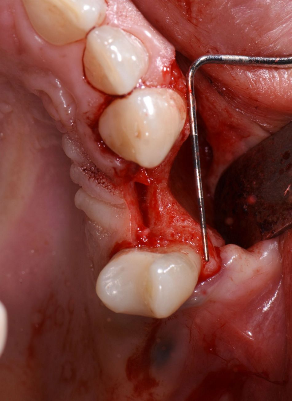 Figure 5: Measuring. The extent of the defect was measured in all 3 dimensions to correctly prepare the bone block graft.