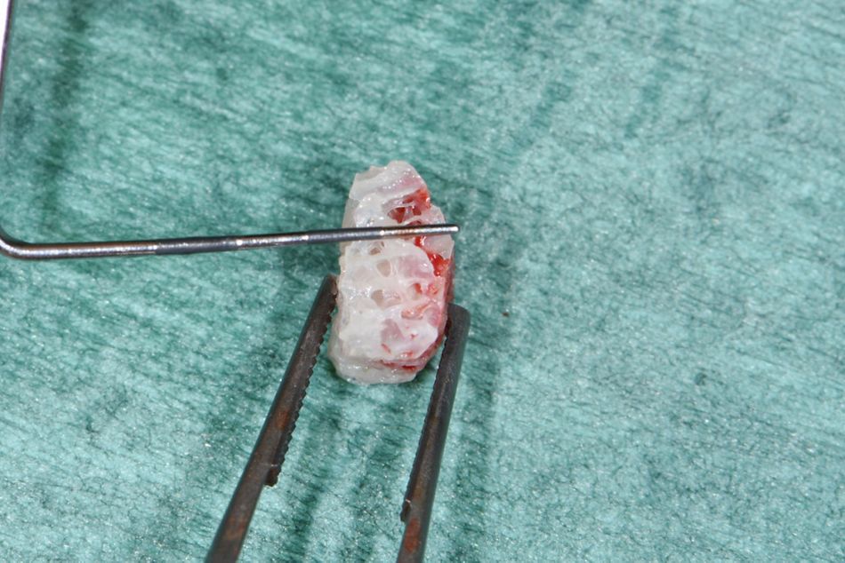 Figure 7: Allogenic bone block graft. Thickness of the prepared block graft.
