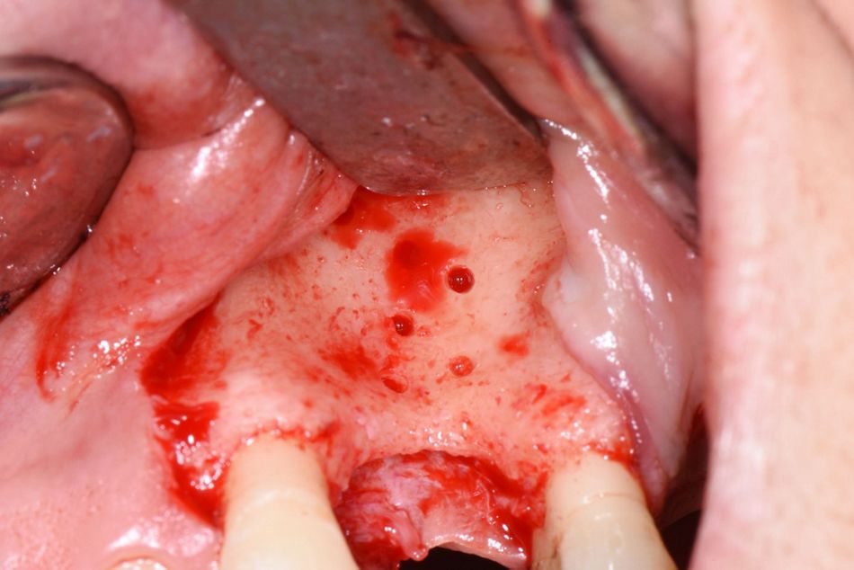 Figure 8: Corticalis perforations. Several perforations of the cortical bone were made to ensure optimal osteogenesis.