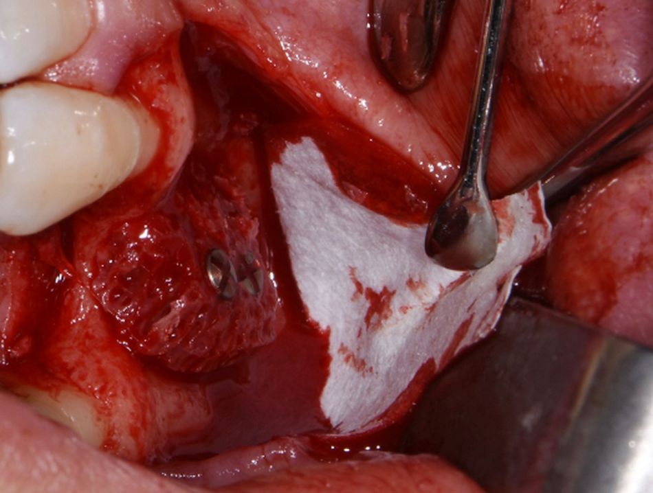 Figure 9: Block graft in situ. The block graft was fixated with 2 osteosynthesis screws.