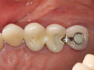GBR treatment protocol with granulated bone grafting