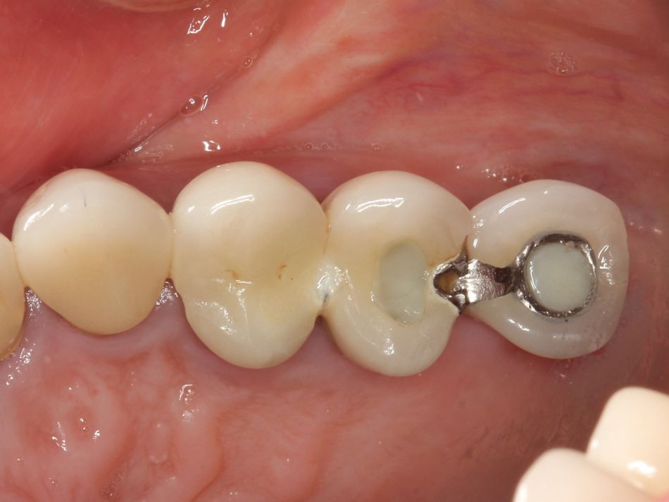 Fig. 1a Preoperative view of failing implant supported prosthesis