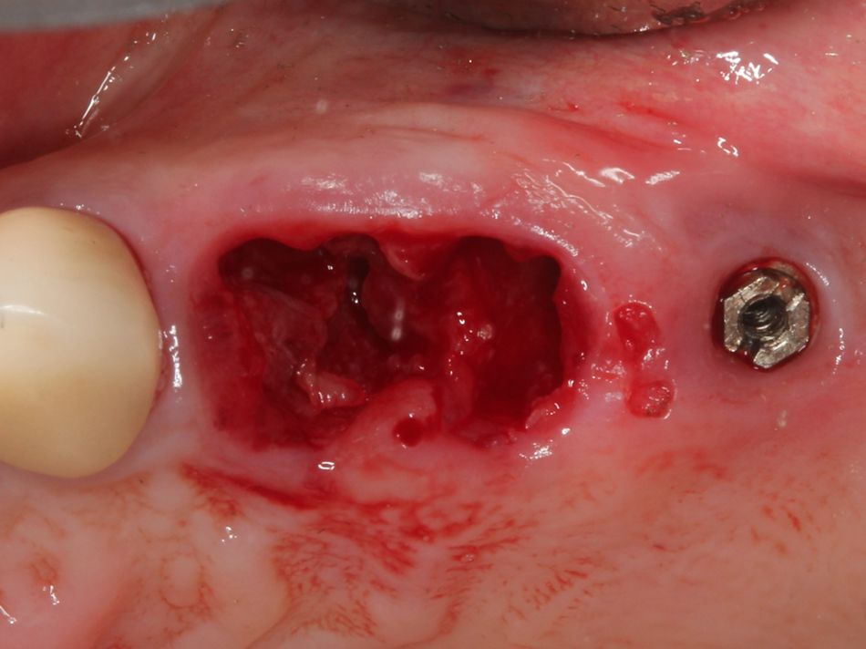 Fig. 1b Extraction of upper left bicuspids