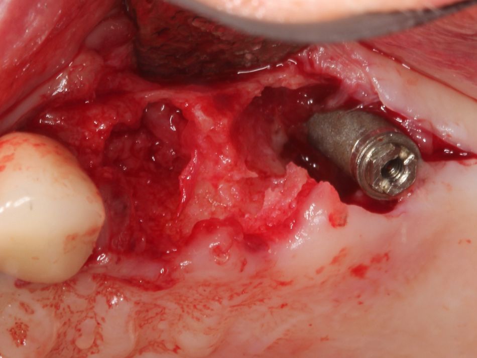 Fig. 1c Full thickness flap elevation revealing bone loss around existing dental implant.