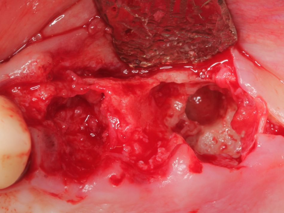 Fig. 1d Removal of failed implant and visualization of large defects