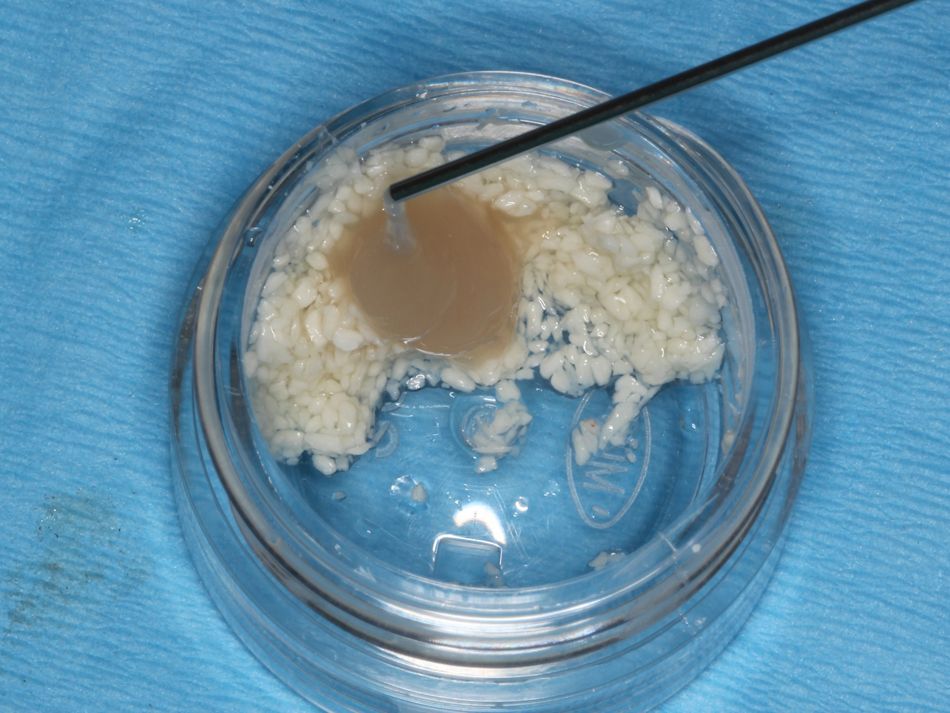 Fig. 1e Mineralized freeze-dried bone allograft mixed with Straumann® Emdogain®