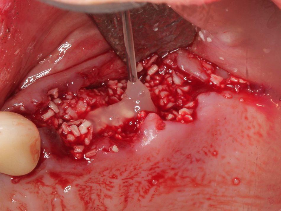 Fig. 1g Straumann® Emdogain® placed over the graft, as well
