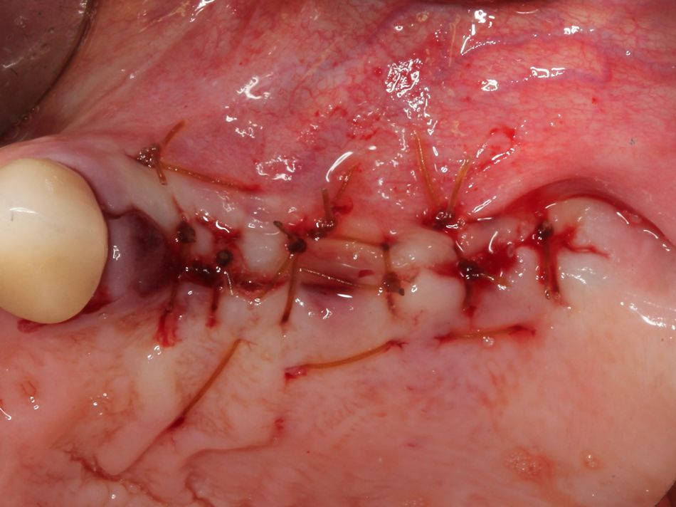 Fig. 1h Horizontal mattress and interrupted sutures to attain primary closure