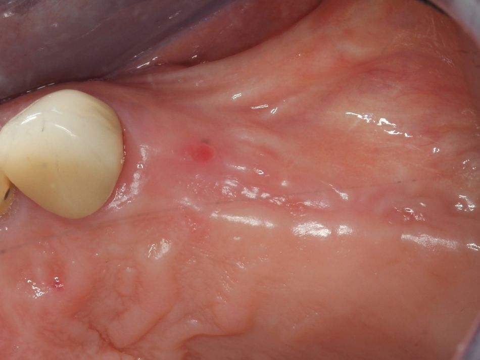 Fig. 1i Soft and hard tissue maturation