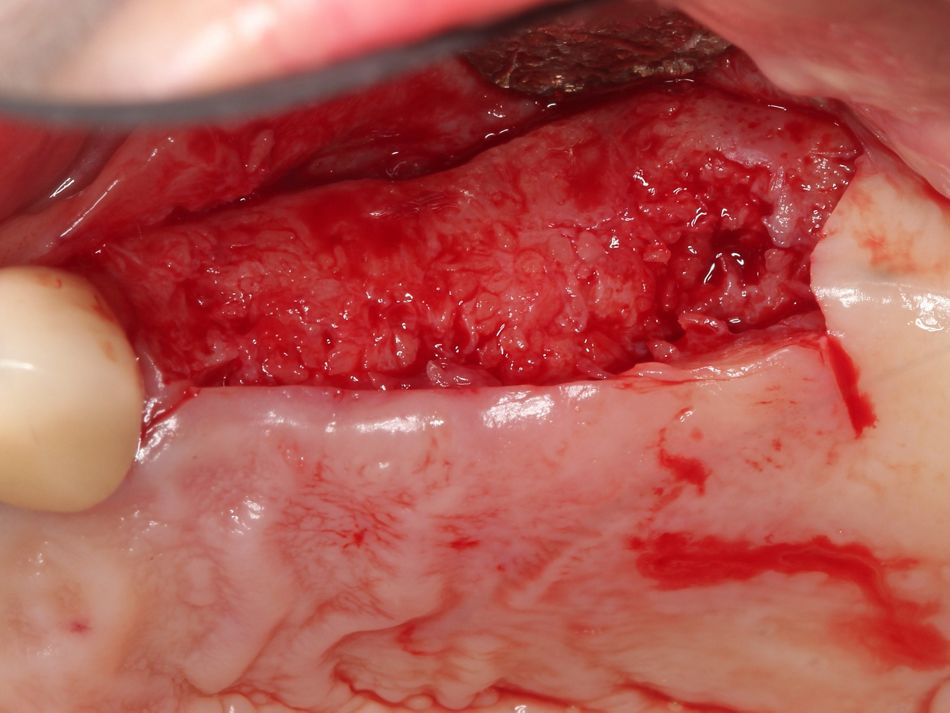 Fig. 1j Flap elevation revealing complete regeneration of the bone defects after 4 months