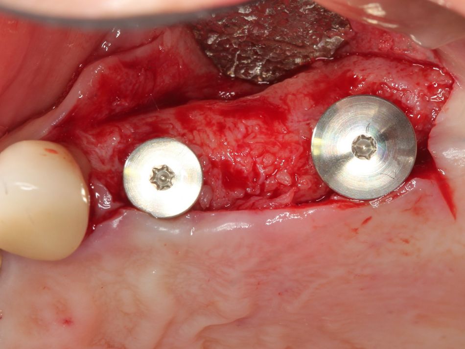 Fig. 1k Implants placement