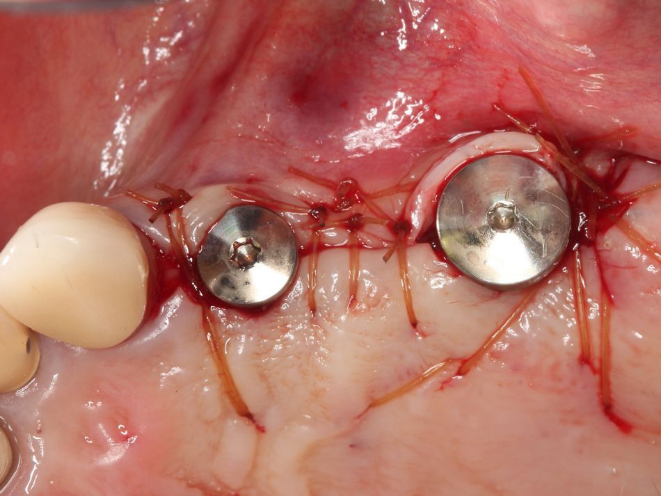 Fig. 1l Sutures