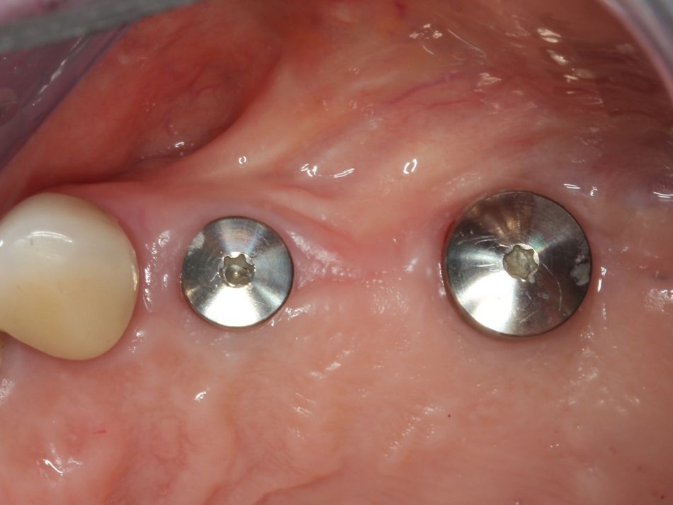 Fig. 1m Osseointegrated implants