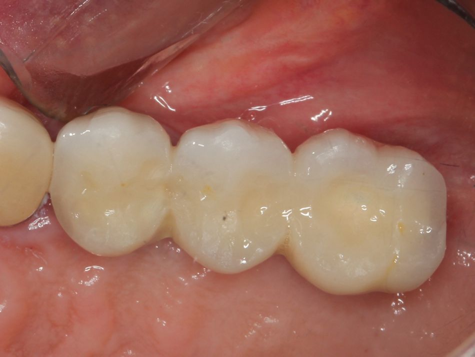 Fig. 1n Final restoration