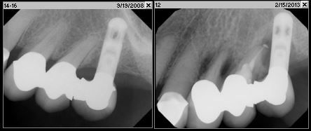 Fig. 1o Radiograph depicting breakdown of prosthesis between 2008 and 2013