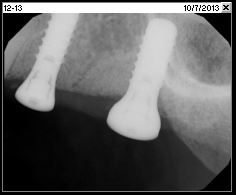 Fig. 1p Periapical radiograph depicting osseointegrated implants (Oct. 2013)