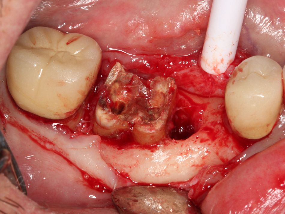 Fig. 2c Full thickness flap elevation, note bone defect mesial to #47