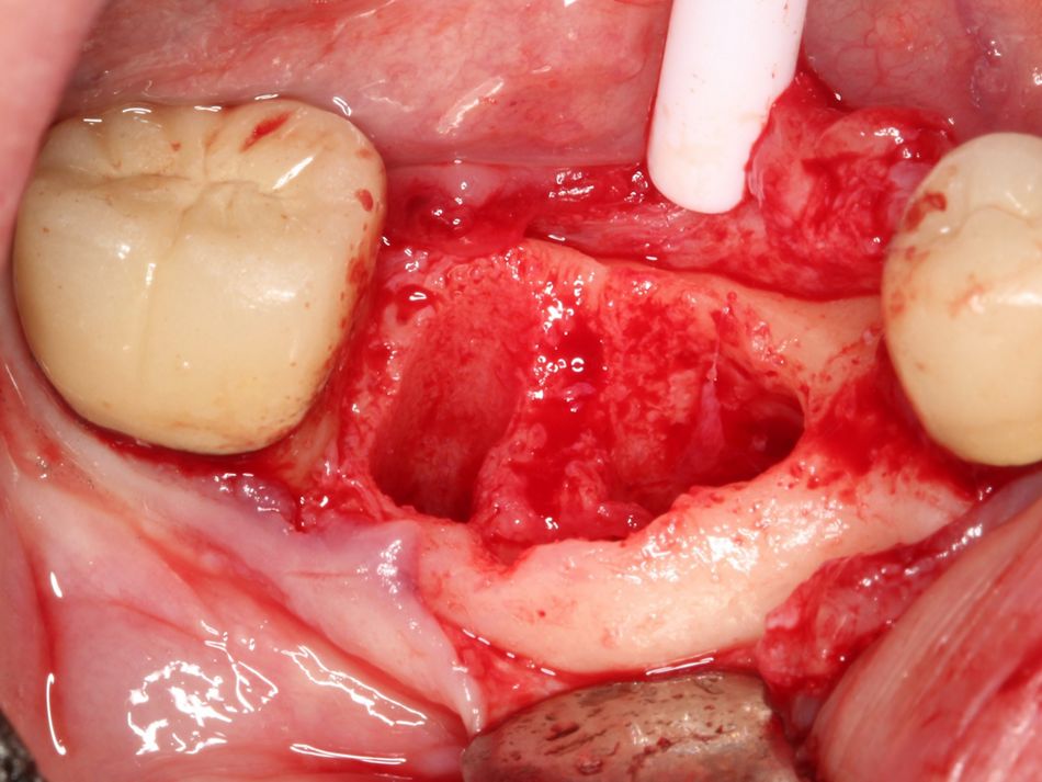 Fig. 2d Extraction indicates that GBR is necessary prior to placement of dental implants