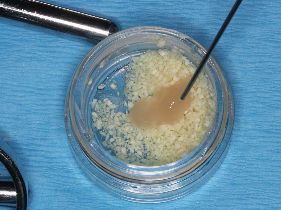 Fig. 2e Straumann® Emdogain® is mixed with mineralized freeze-dried bone Straumann® Allograft