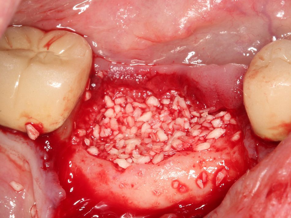 Fig. 2f The mixture is placed on the extraction socket and in the bone defect
