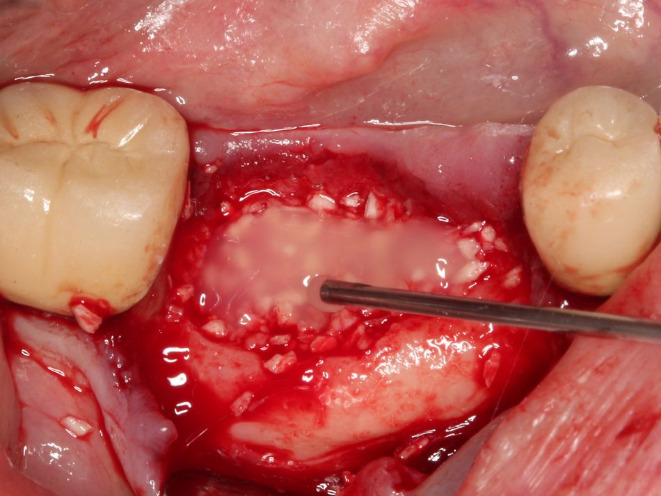 Fig. 2g Straumann® Emdogain® is placed on the superior aspect of the graft, prior to closure
