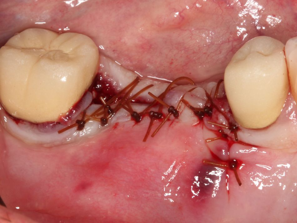 Fig. 2h Primary closure achieved with horizontal mattress and interrupted suturing