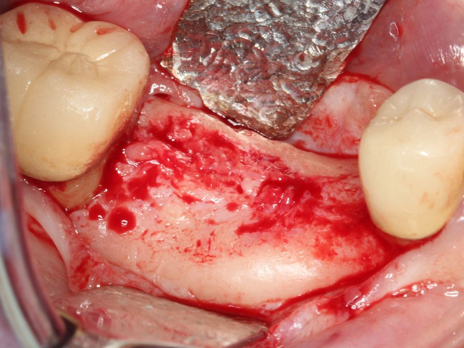 Fig. 2j Full thickness flap elevation after twelve weeks revealing complete regeneration of the ridge