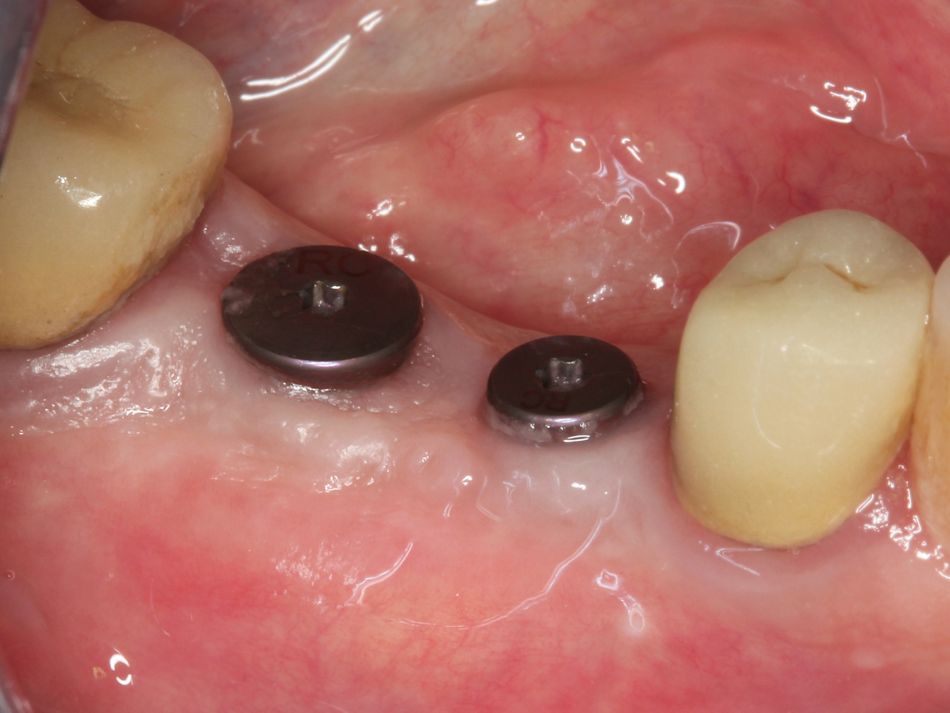 Fig. 2m Healing
