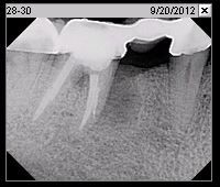Fig. 2o Pre-operative radiograph (Sep. 2012)