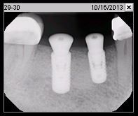 Fig. 2p Periapical radiograph of osseointegrated implants (Oct. 2013)