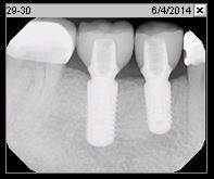 Fig. 2q Periapical radiograph of final restoration (Jun. 2014)