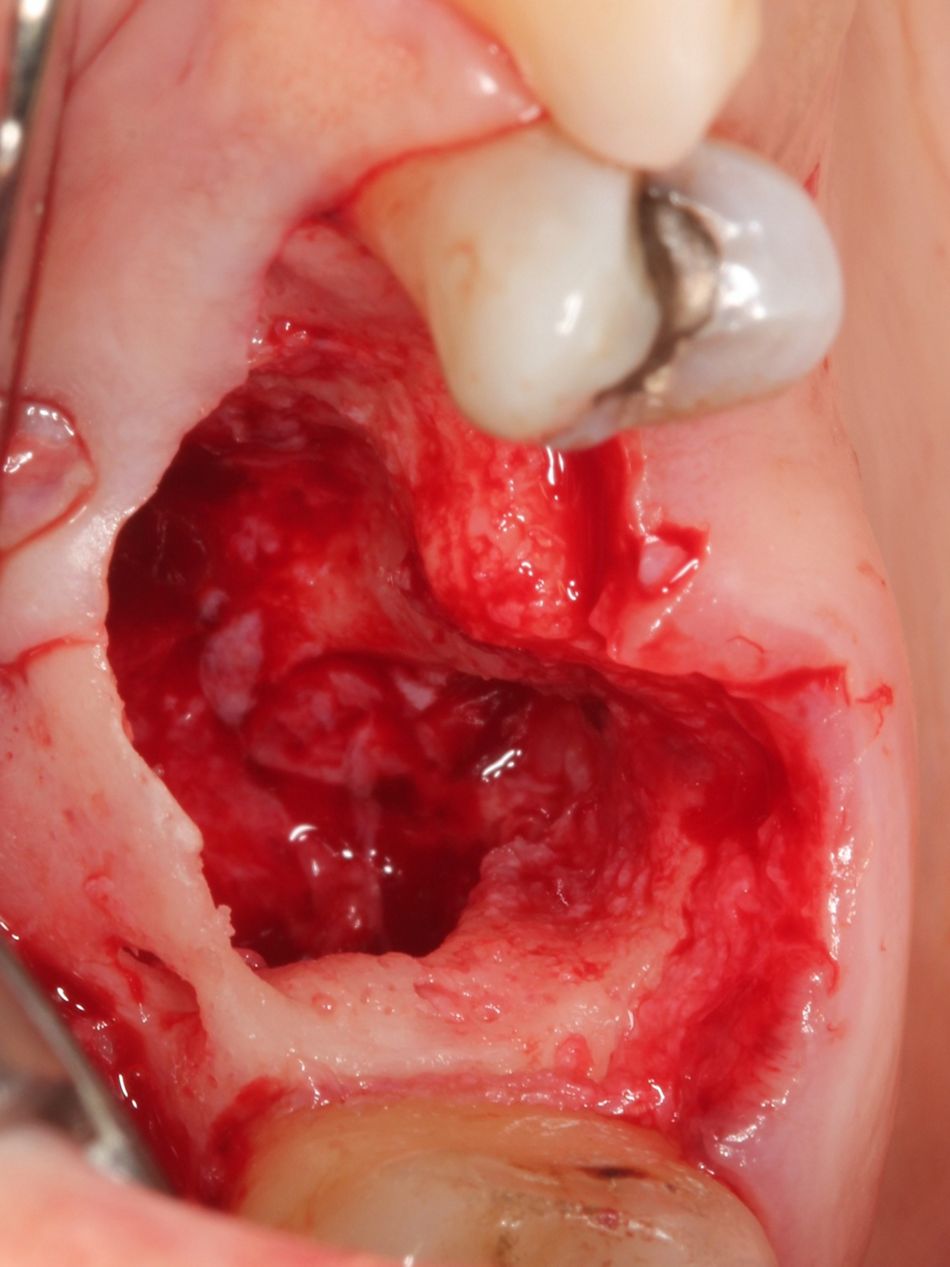 Fig. 3a  Extraction with thorough debridement of extraction site 