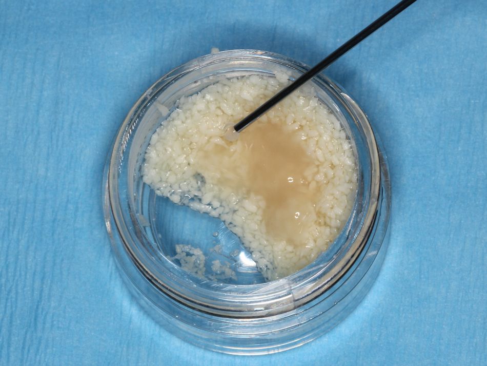 Fig. 3b  Freeze-dried bone Allograft mixed with Emdogain