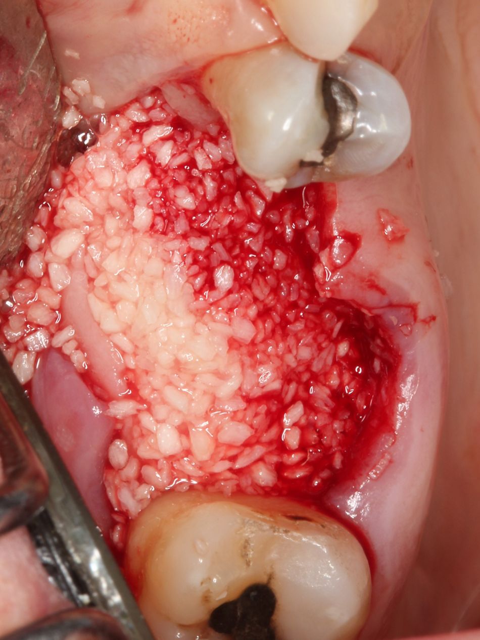 Fig. 3c  Graft placed in the extraction site