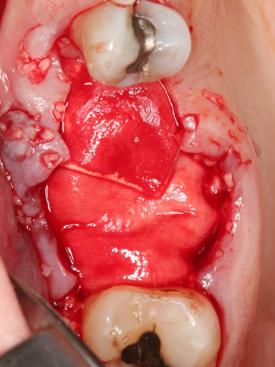 Fig. 3d Primary closure could not be attained necessitating the use of a collagen membrane