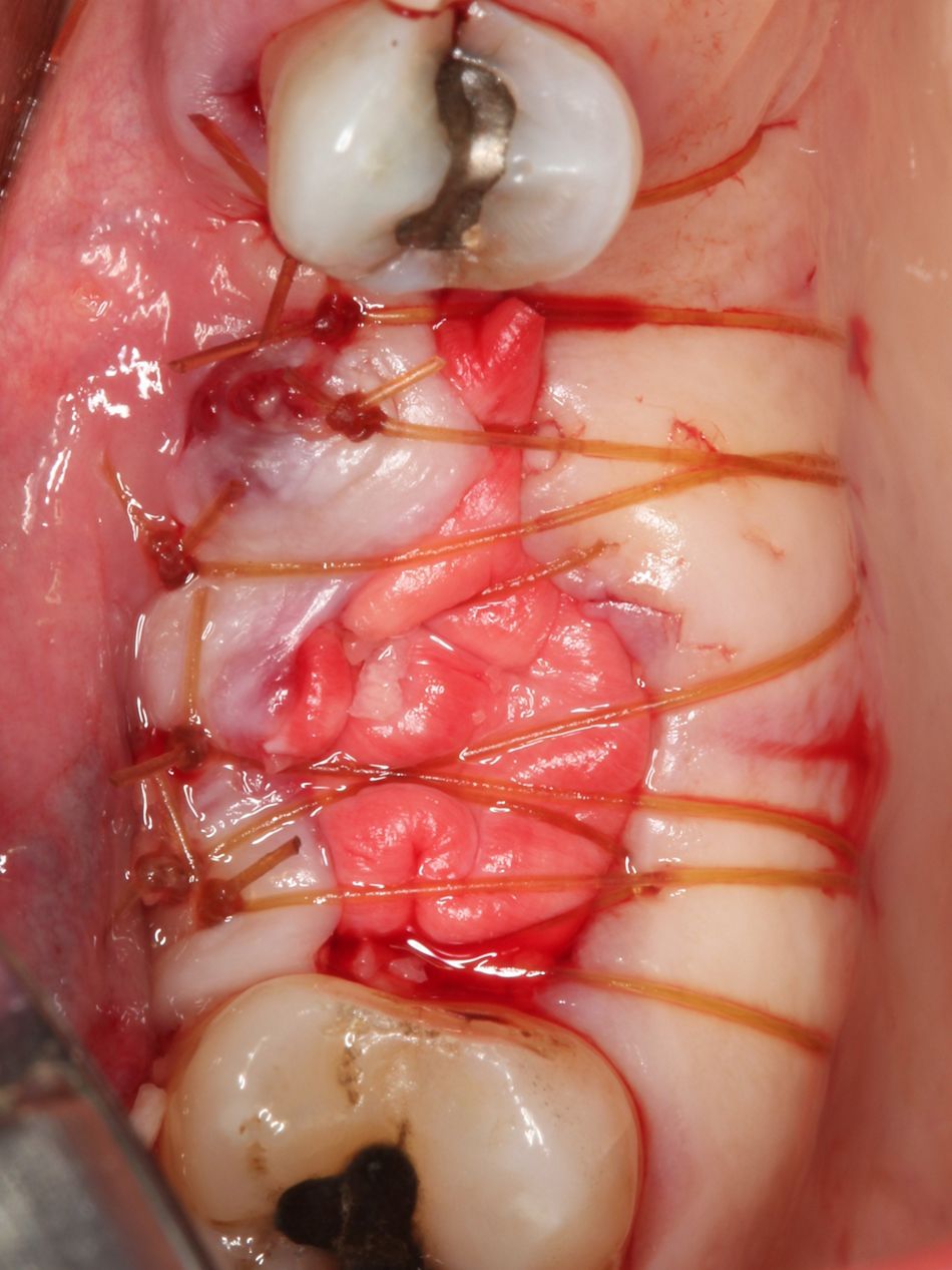 Fig. 3e Suturing