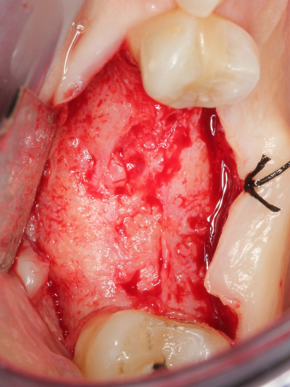 Fig. 3g Reentry at fourteen weeks