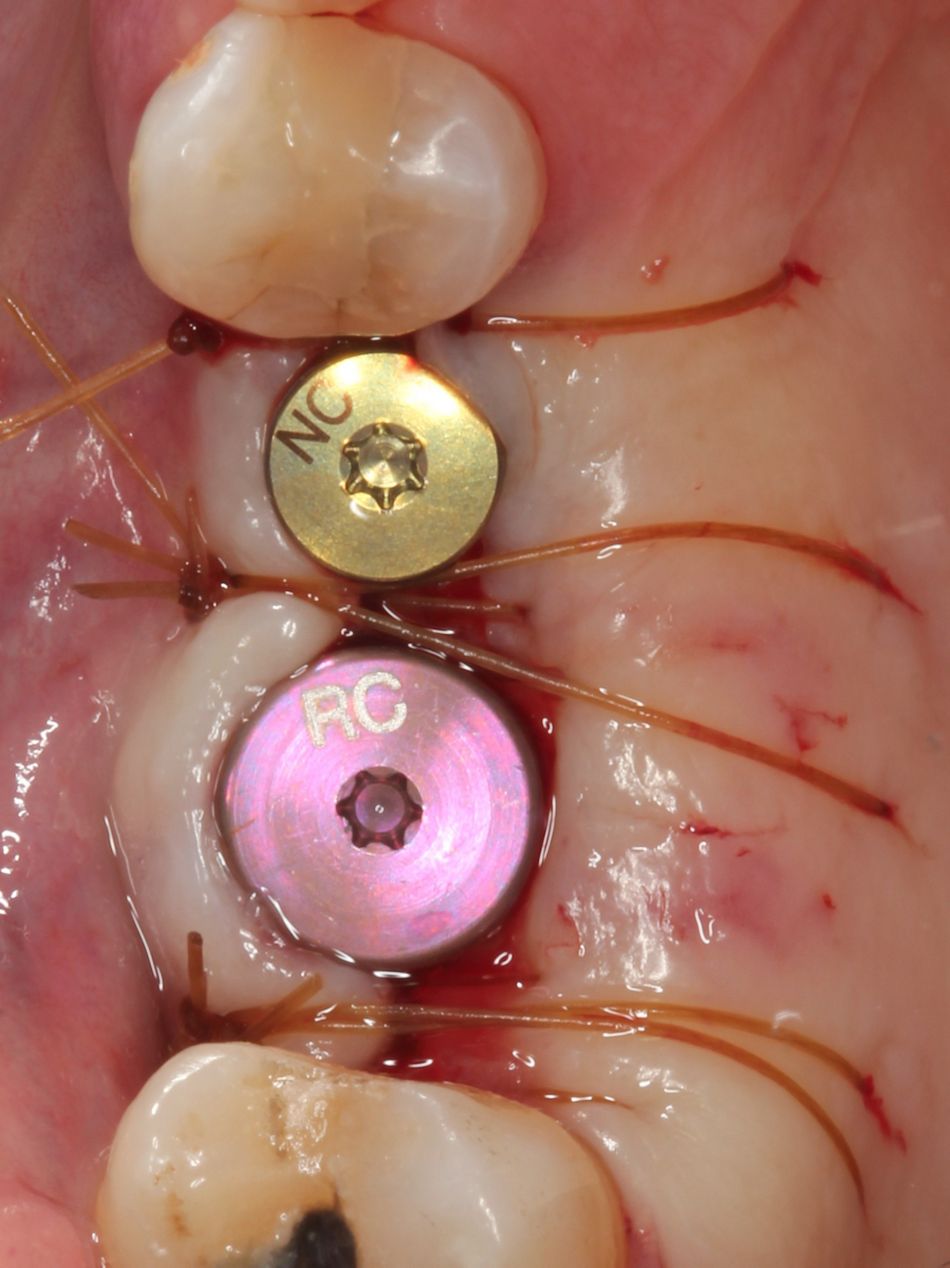 Fig. 3i Transmucosal healing abutments