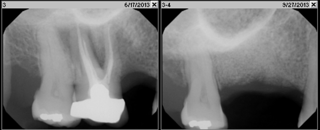 Fig. 3j Radiographs depicting excellent quality of bone enabling predictable implant placement