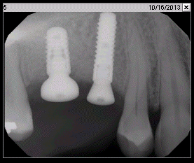 Fig. 3k Implant placement (Oct. 2013)