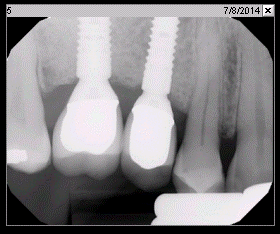 Fig. 3l Final restoration (Jul. 2014)