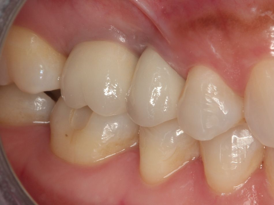 Fig. 3m Buccal view of final restoration