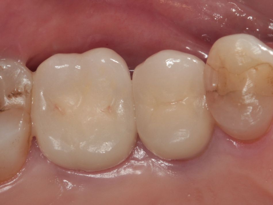 Fig. 3n Occlusal view of final restoration