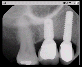 Fig. 3o X-ray 4 years after implant insertion (Mar. 2017)