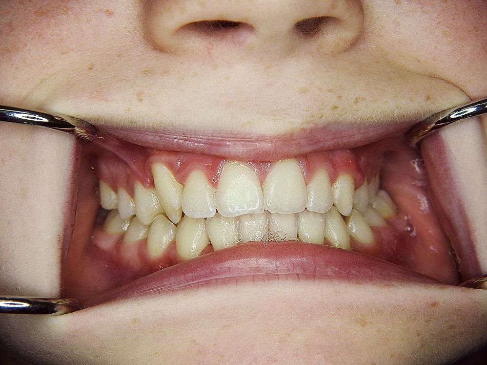 Fig. 1a: Anterior view before treatment