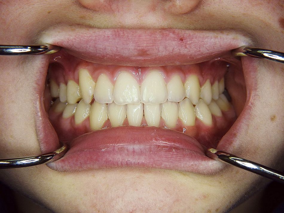 Fig. 1b: Anterior view after treatment