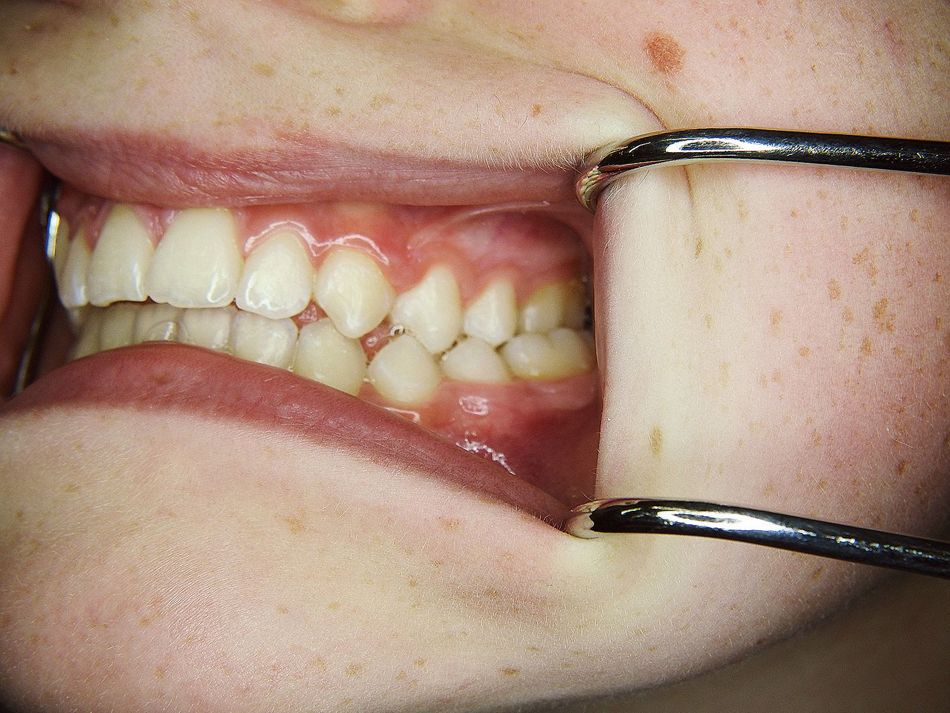 Fig. 1c: Lateral view from left before treatment
